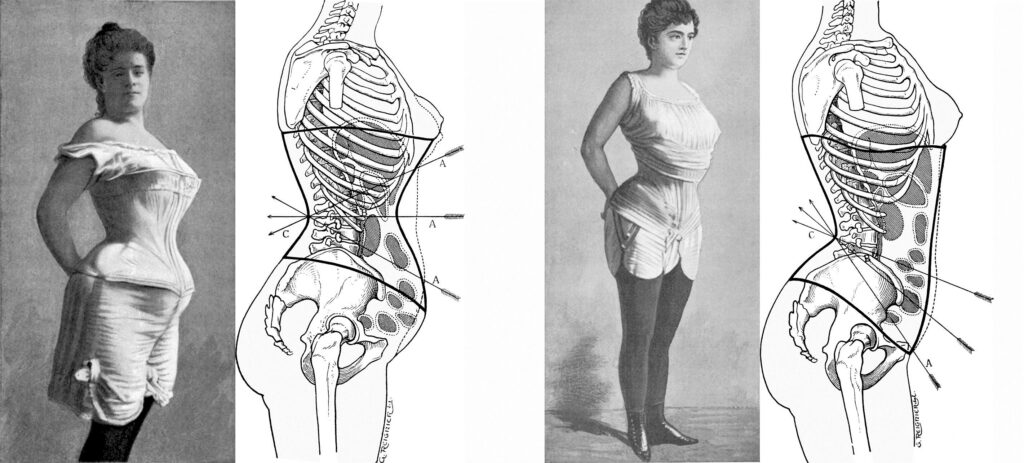 Comparación anatómica de los efectos del corsé sablier y del corsé abdominal sobre el cuerpo femenino